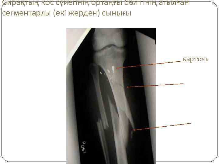 Сирақтың қос сүйегінің ортаңғы бөлігінің атылған сегментарлы (екі жерден) сынығы картечь 