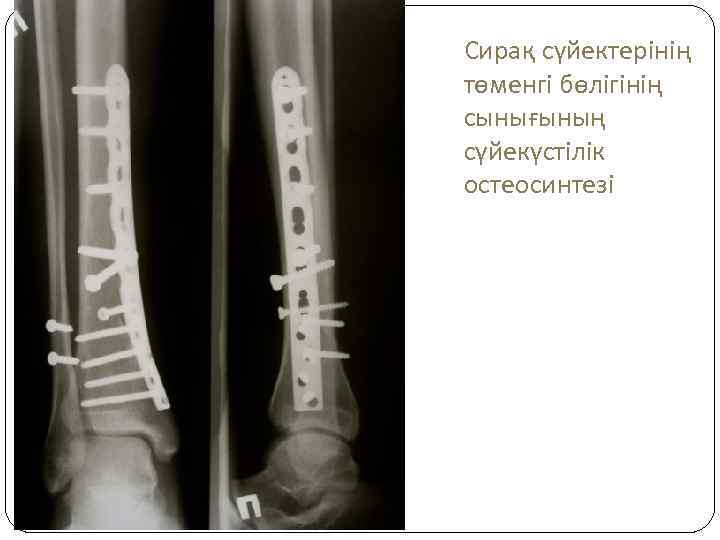 Сирақ сүйектерінің төменгі бөлігінің сынығының сүйекүстілік остеосинтезі 
