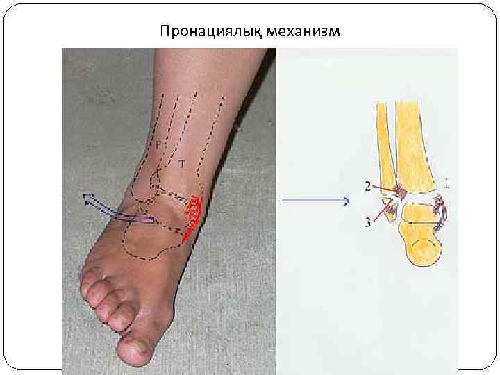 Пронациялық механизм 