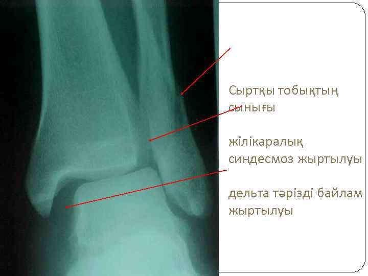 Сыртқы тобықтың сынығы жілікаралық синдесмоз жыртылуы дельта тәрізді байлам жыртылуы 