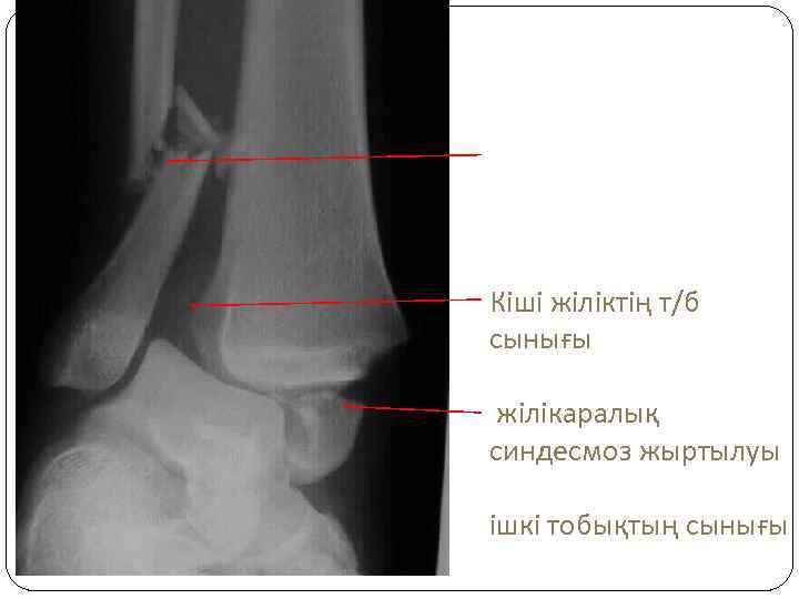 Кіші жіліктің т/б сынығы жілікаралық синдесмоз жыртылуы ішкі тобықтың сынығы 