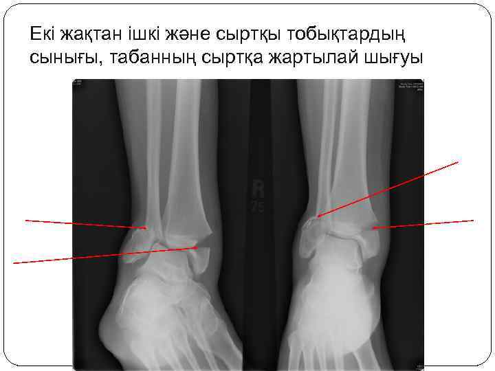 Екі жақтан ішкі және сыртқы тобықтардың сынығы, табанның сыртқа жартылай шығуы 