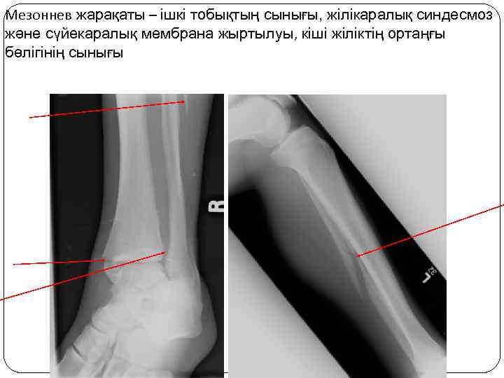 Мезоннев жарақаты – ішкі тобықтың сынығы, жілікаралық синдесмоз және сүйекаралық мембрана жыртылуы, кіші жіліктің