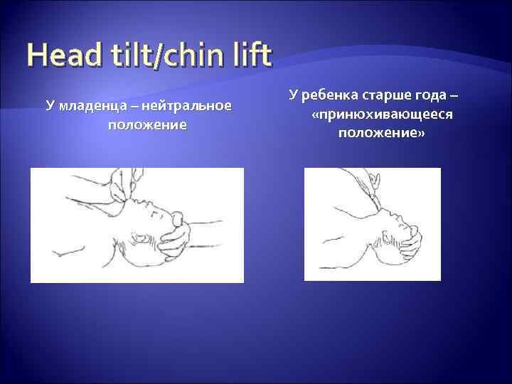 Head tilt/chin lift У младенца – нейтральное положение У ребенка старше года – «принюхивающееся