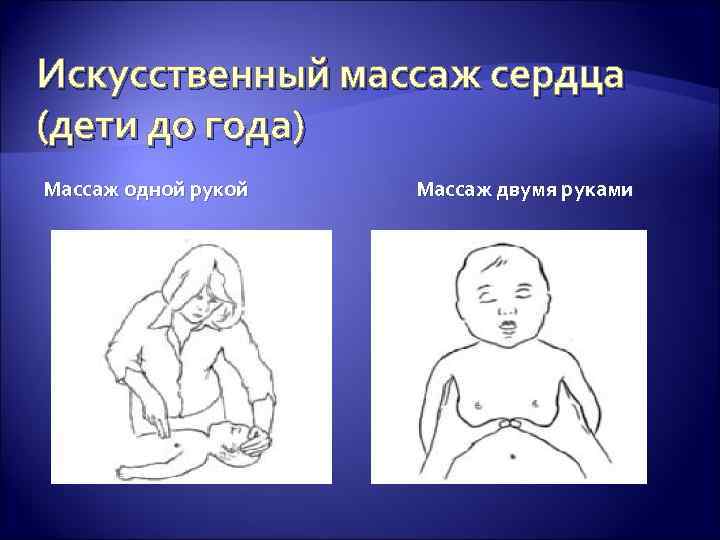 Искусственный массаж сердца (дети до года) Массаж одной рукой Массаж двумя руками 