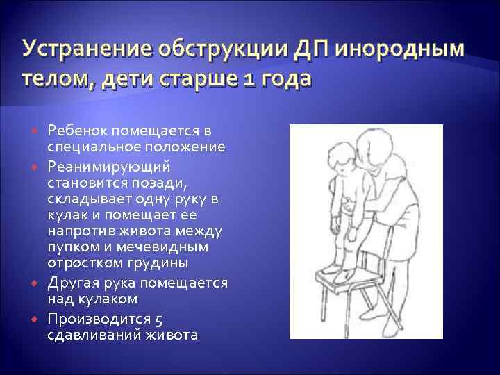 Устранение обструкции ДП инородным телом, дети старше 1 года Ребенок помещается в специальное положение