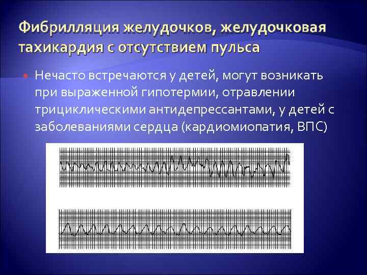 Фибрилляция желудочков, желудочковая тахикардия с отсутствием пульса Нечасто встречаются у детей, могут возникать при