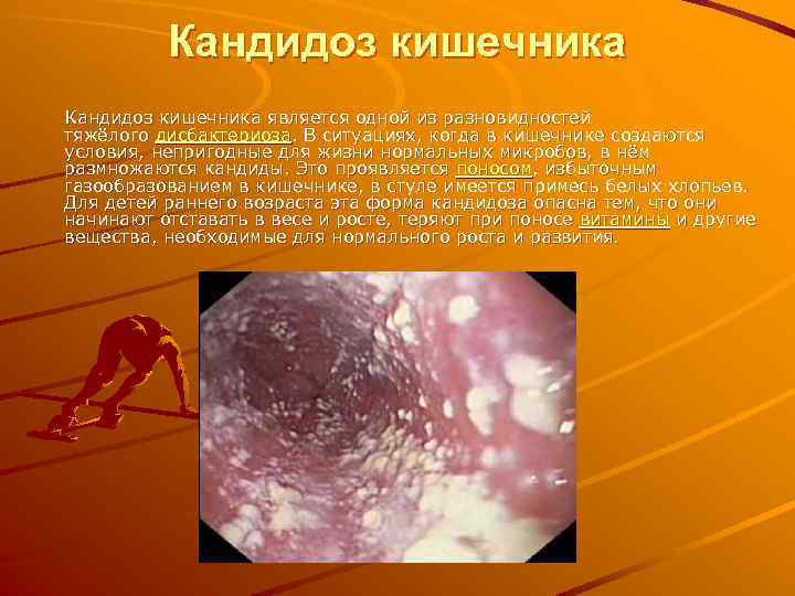Кандидоз кишечника является одной из разновидностей тяжёлого дисбактериоза. В ситуациях, когда в кишечнике создаются