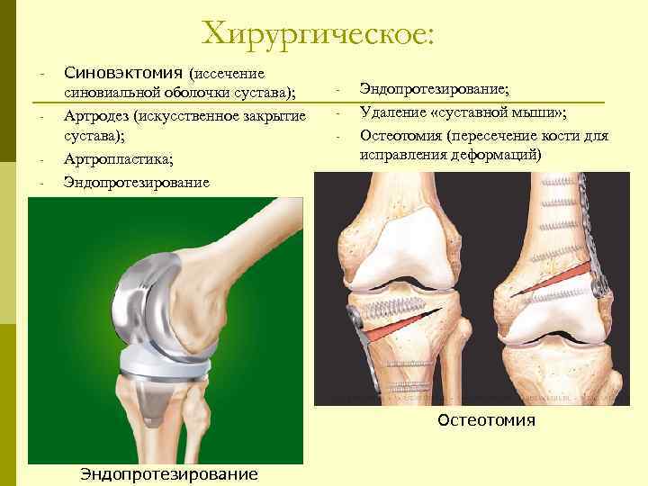 Хирургическое: - Синовэктомия (иссечение синовиальной оболочки сустава); Артродез (искусственное закрытие сустава); Артропластика; Эндопротезирование -