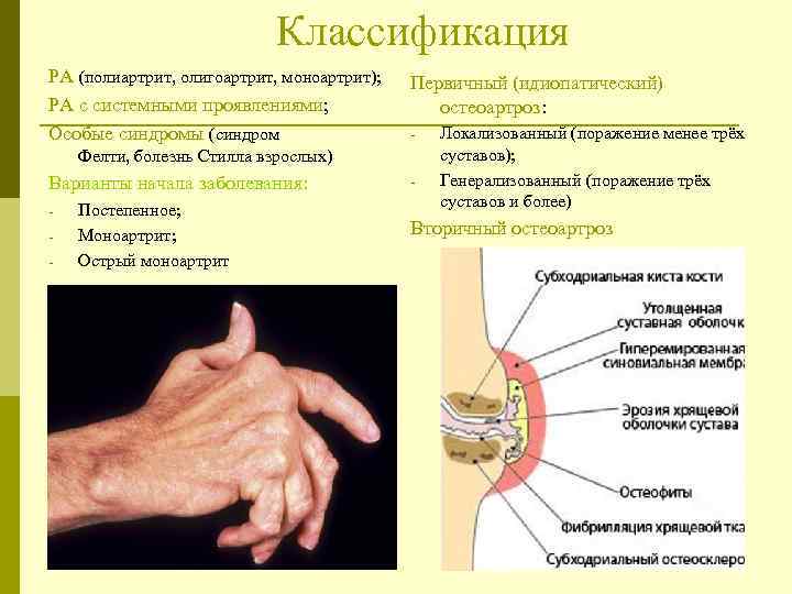  Классификация РА (полиартрит, олигоартрит, моноартрит); РА с системными проявлениями; Особые синдромы (синдром Первичный