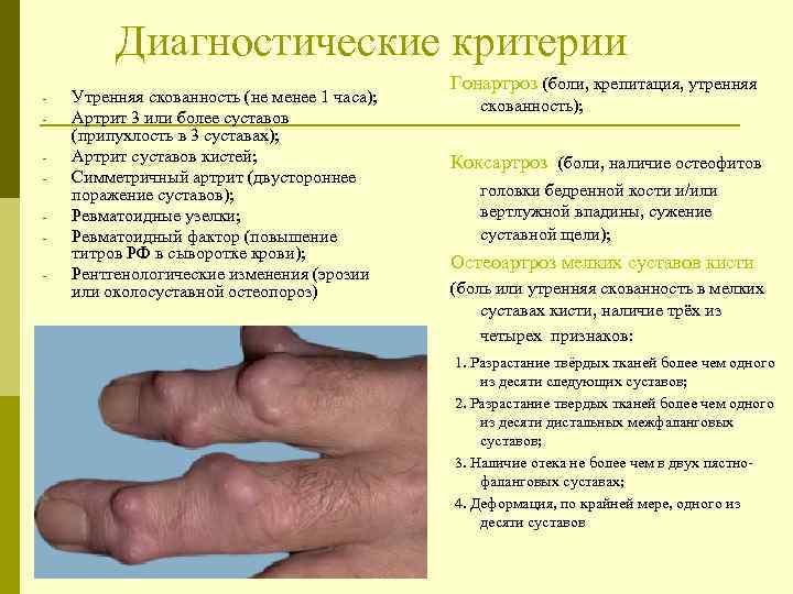  Диагностические критерии - Утренняя скованность (не менее 1 часа); Артрит 3 или более