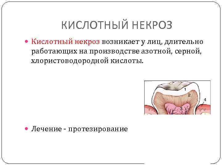 КИСЛОТНЫЙ НЕКРОЗ Кислотный некроз возникает у лиц, длительно работающих на производстве азотной, серной, хлористоводородной
