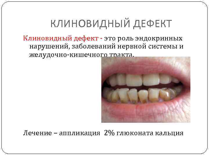 КЛИНОВИДНЫЙ ДЕФЕКТ Клиновидный дефект - это роль эндокринных нарушений, заболеваний нервной системы и желудочно-кишечного