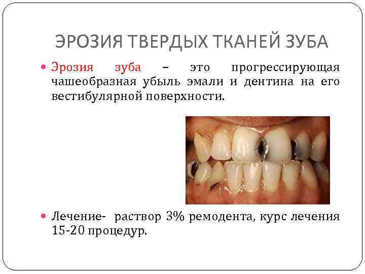 ЭРОЗИЯ ТВЕРДЫХ ТКАНЕЙ ЗУБА Эрозия зуба – это прогрессирующая чашеобразная убыль эмали и дентина