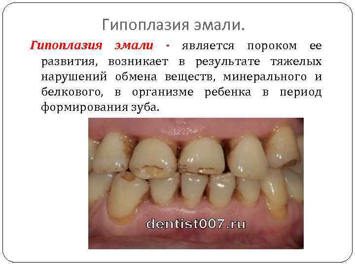 Гипоплазия эмали - является пороком ее развития, возникает в результате тяжелых нарушений обмена веществ,