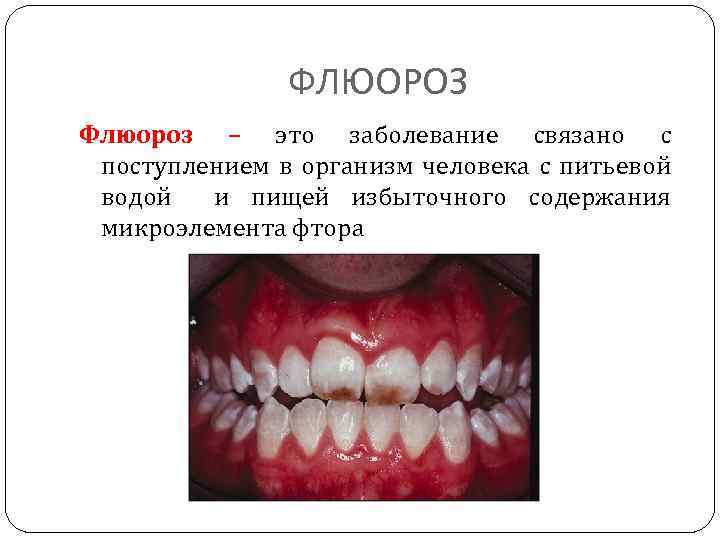 ФЛЮОРОЗ Флюороз – это заболевание связано с поступлением в организм человека с питьевой водой