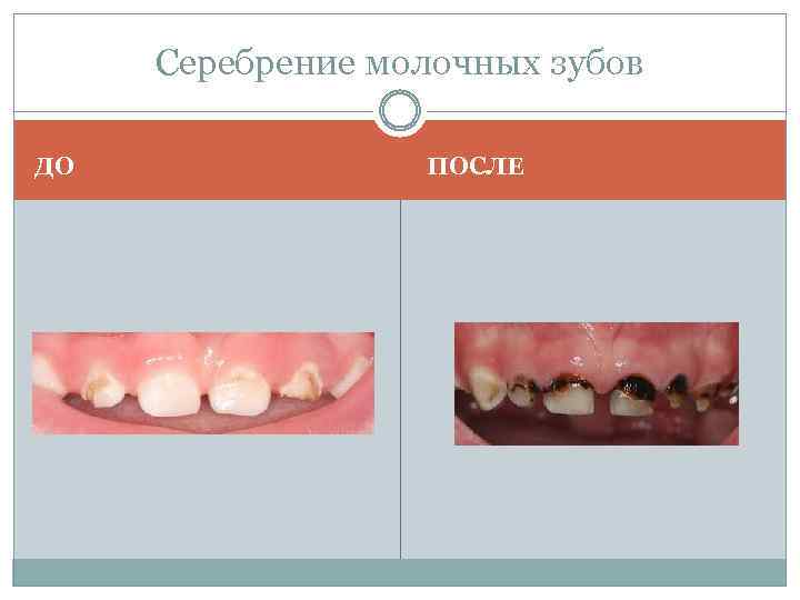 Серебрение молочных зубов ДО ПОСЛЕ 