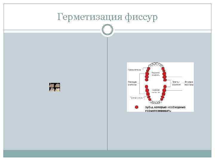 Герметизация фиссур 