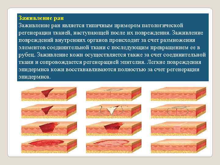 Заживление ран является типичным примером патологической регенерации тканей, наступающей после их повреждения. Заживление повреждений