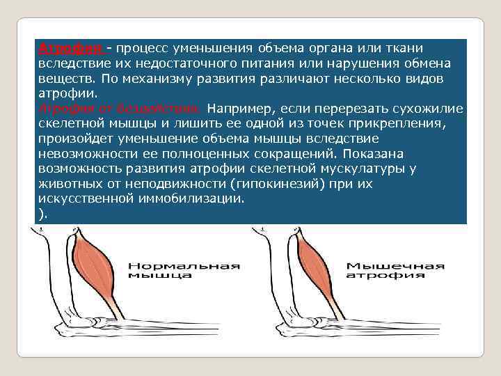 Атрофия - процесс уменьшения объема органа или ткани вследствие их недостаточного питания или нарушения