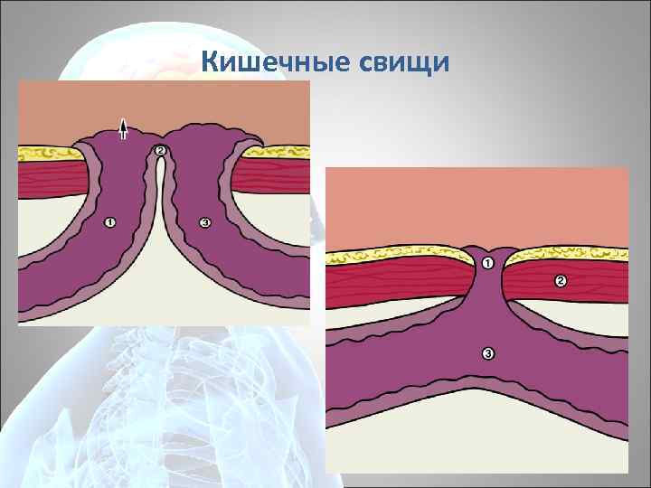 Кишечные свищи 