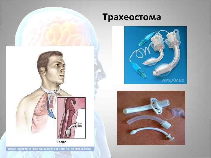 Уход за трахеостомой презентация