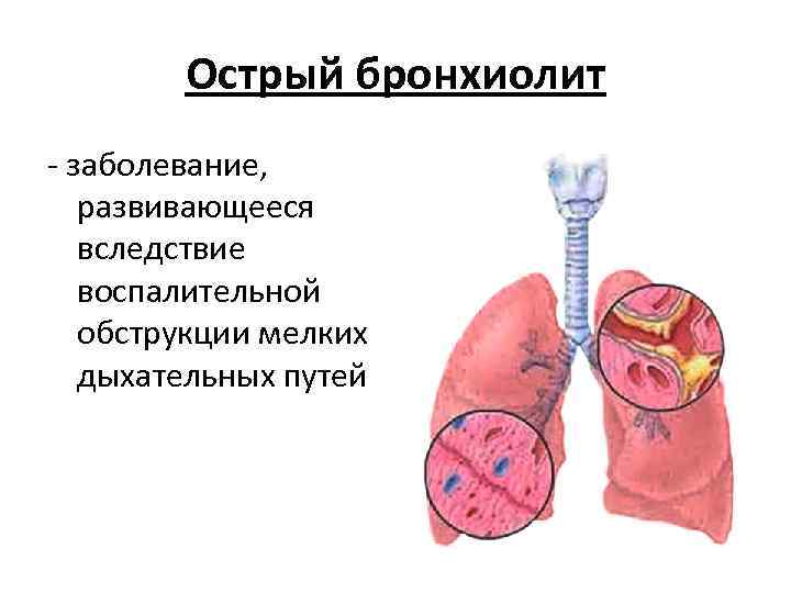 Острый бронхиолит - заболевание, развивающееся вследствие воспалительной обструкции мелких дыхательных путей 