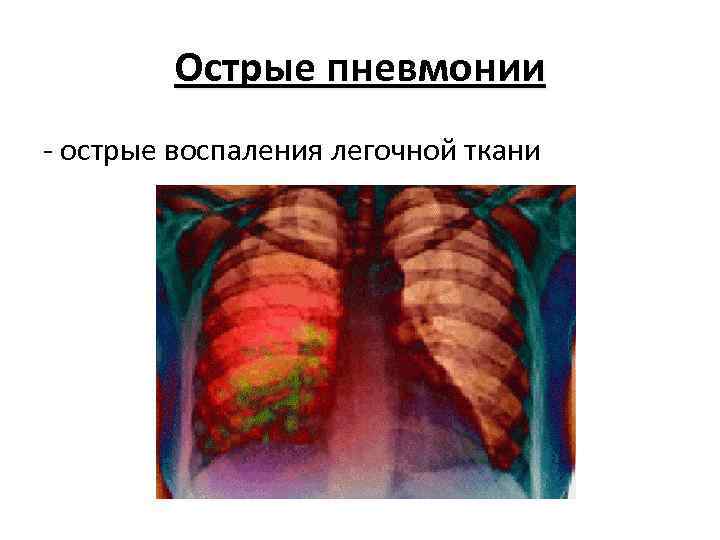 Острые пневмонии - острые воспаления легочной ткани 