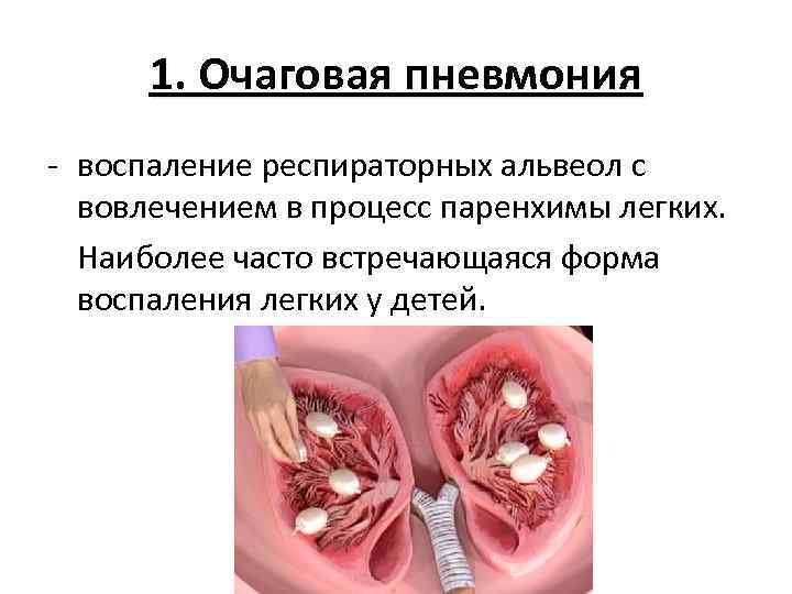 1. Очаговая пневмония - воспаление респираторных альвеол с вовлечением в процесс паренхимы легких. Наиболее