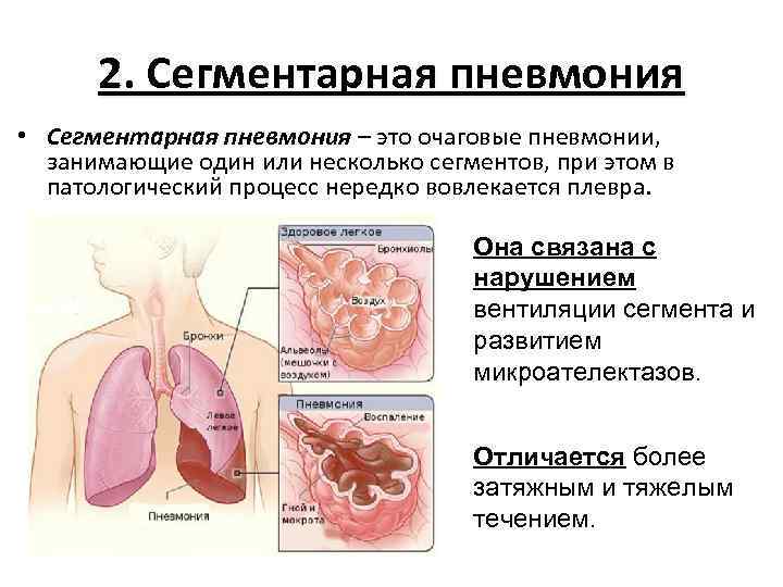 2. Сегментарная пневмония • Сегментарная пневмония – это очаговые пневмонии, занимающие один или несколько