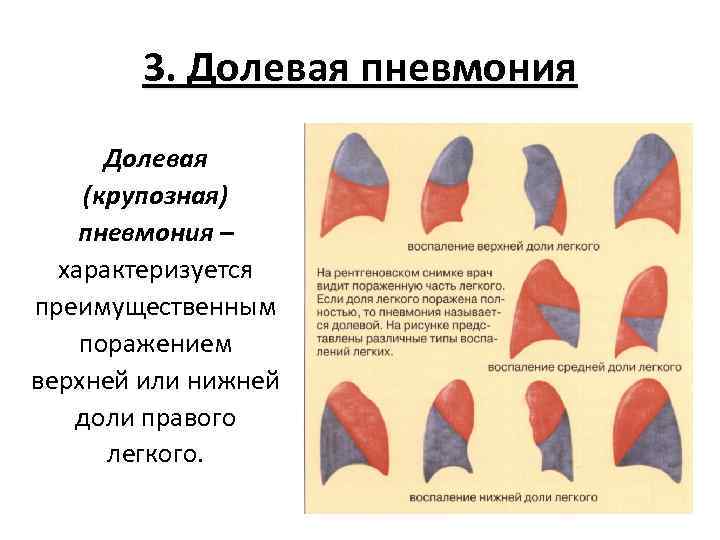 3. Долевая пневмония Долевая (крупозная) пневмония – характеризуется преимущественным поражением верхней или нижней доли