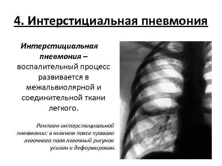 4. Интерстициальная пневмония – воспалительный процесс развивается в межальвиолярной и соединительной ткани легкого. Рентген