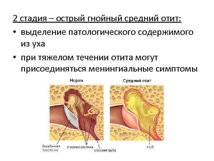 2 стадия – острый гнойный средний отит: • выделение патологического содержимого из уха •