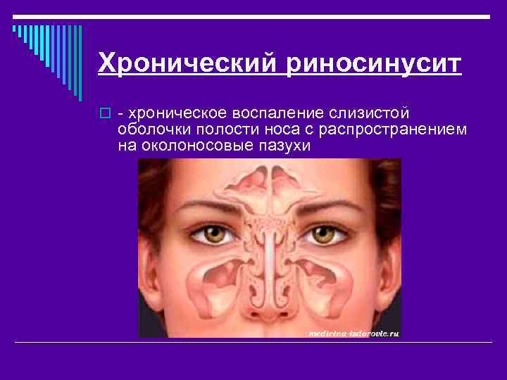 Хронический риносинусит o - хроническое воспаление слизистой оболочки полости носа с распространением на околоносовые