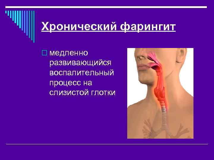 Хронический фарингит o медленно развивающийся воспалительный процесс на слизистой глотки 