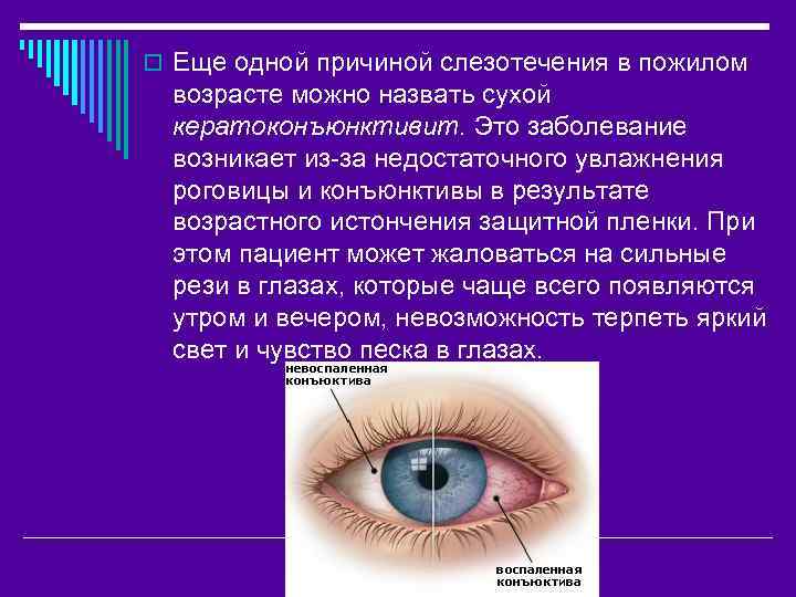 o Еще одной причиной слезотечения в пожилом возрасте можно назвать сухой кератоконъюнктивит. Это заболевание