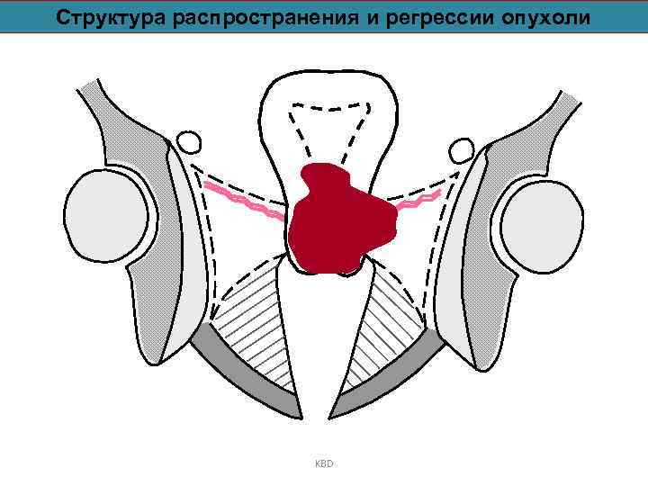 Структура распространения и регрессии опухоли KBD 
