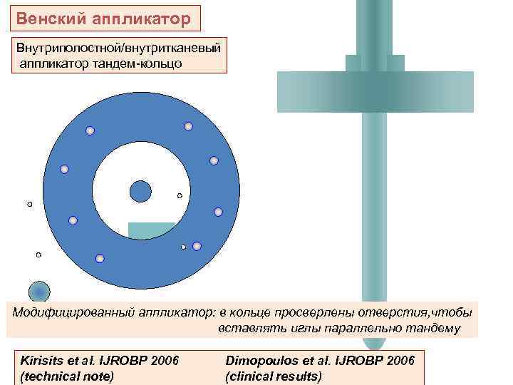 Венский аппликатор Внутриполостной/внутритканевый аппликатор тандем-кольцо Модифицированный аппликатор: в кольце просверлены отверстия, чтобы вставлять иглы