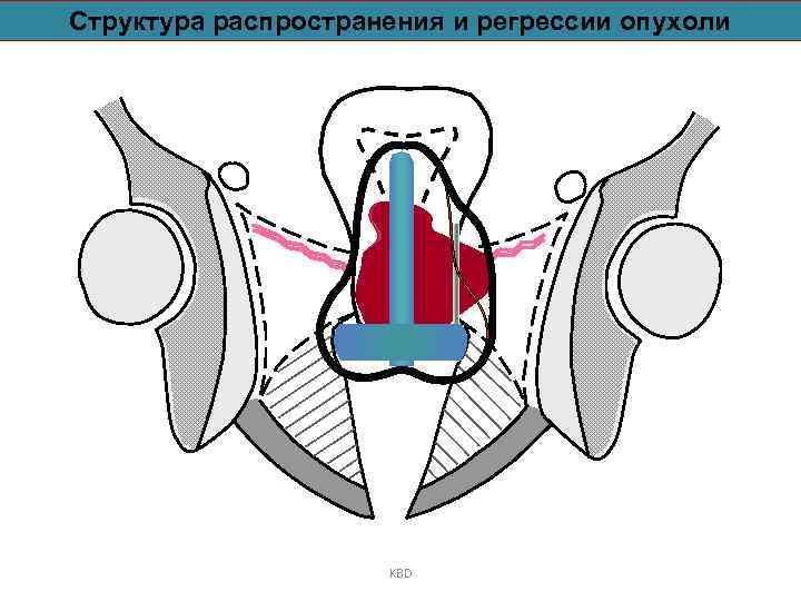 Структура распространения и регрессии опухоли KBD 