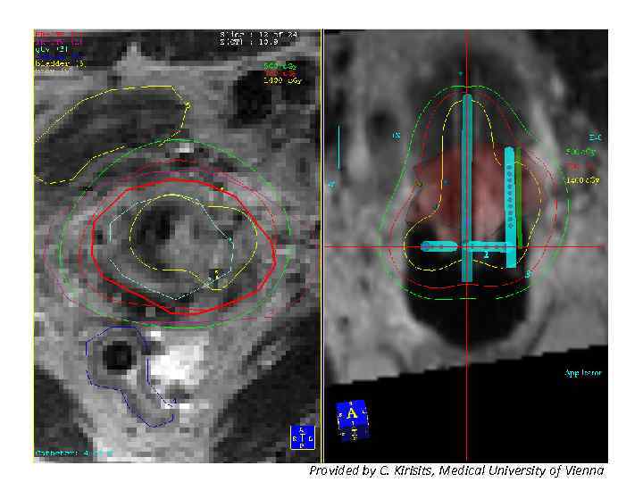 Графическая оптимизация Provided by C. Kirisits, Medical University of Vienna 