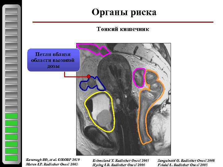 Органы риска Тонкий кишечник Петли вблизи области высокой дозы Kavanagh BD, et al. IJROBP