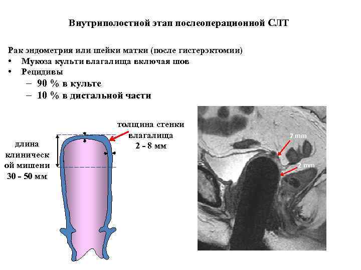 Внутриполостной этап послеоперационной СЛТ Рак эндометрия или шейки матки (после гистерэктомии) • Mукоза культи