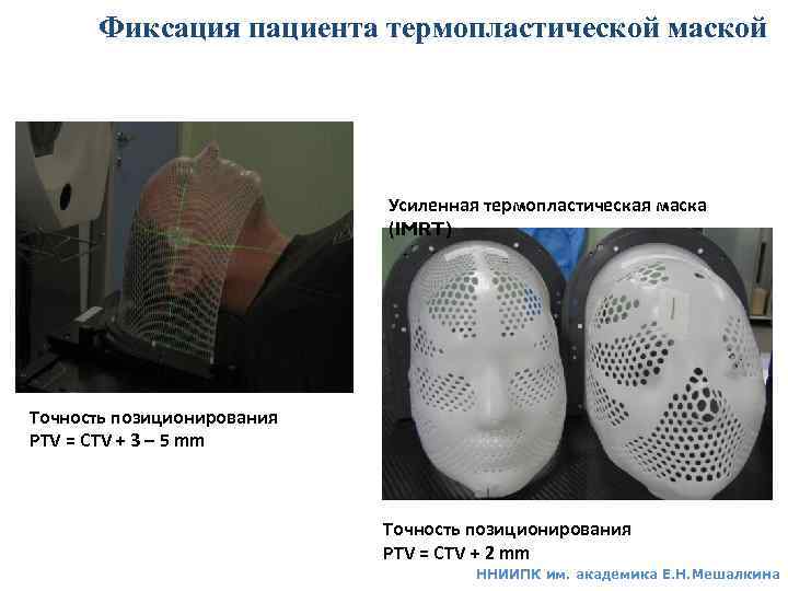 Фиксация пациента термопластической маской Усиленная термопластическая маска (IMRT) Точность позиционирования PTV = CTV +