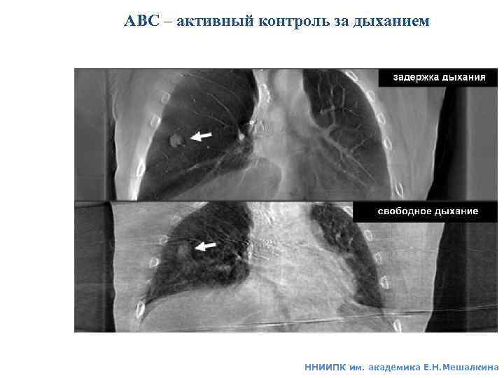 АВС – активный контроль за дыханием ННИИПК им. академика Е. Н. Мешалкина 