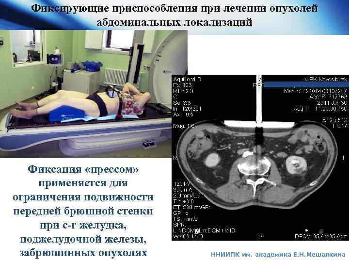 Фиксирующие приспособления при лечении опухолей абдоминальных локализаций Фиксация «прессом» применяется для ограничения подвижности передней