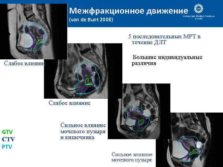 Межфракционное движение (van de Bunt 2008) 5 последовательных MРТ в течение ДЛТ Большие индивидуальные