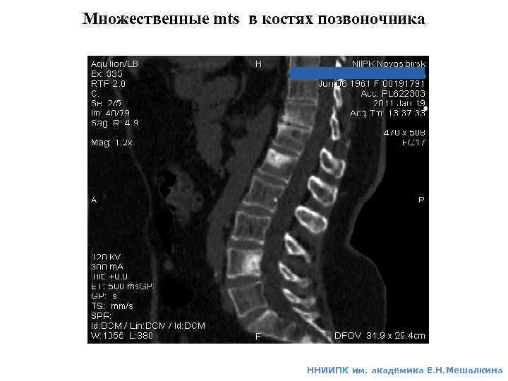 Множественные mts в костях позвоночника ННИИПК им. академика Е. Н. Мешалкина 
