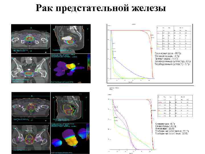Рак предстательной железы 