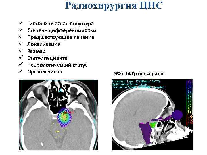Радиохирургия ЦНС ü ü ü ü Гистологическая структура Степень дифференцировки Предшествующее лечение Локализация Размер