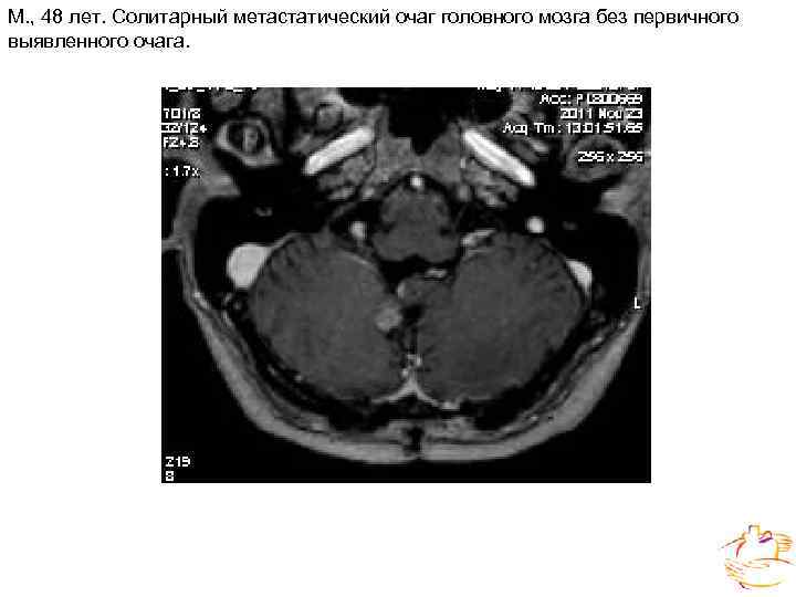 М. , 48 лет. Солитарный метастатический очаг головного мозга без первичного выявленного очага. 